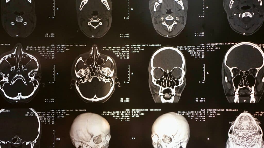 STAT+: With successful trials, Roche takes its MS drug to regulators, but safety questions loom