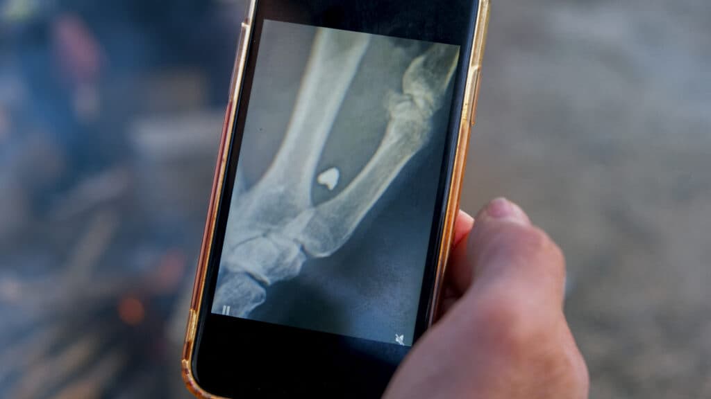 Opinion: Living with bullet fragments in the body can have long-term medical consequences