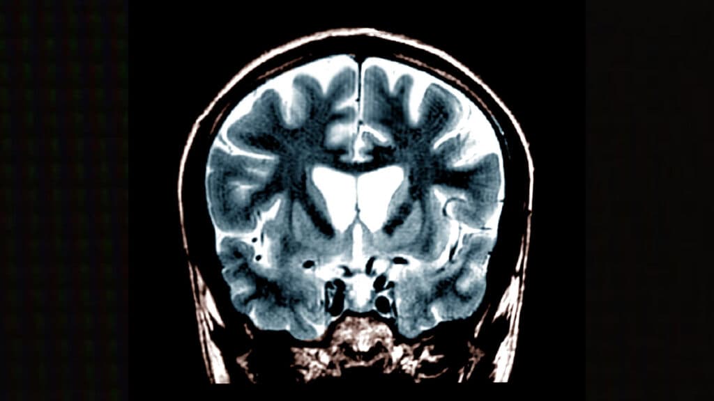 STAT+: Biotech raises $42 million to run Huntington’s disease trial