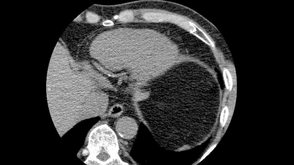 On the fence about a statin? In borderline cases, calcium scans could be a tiebreaker