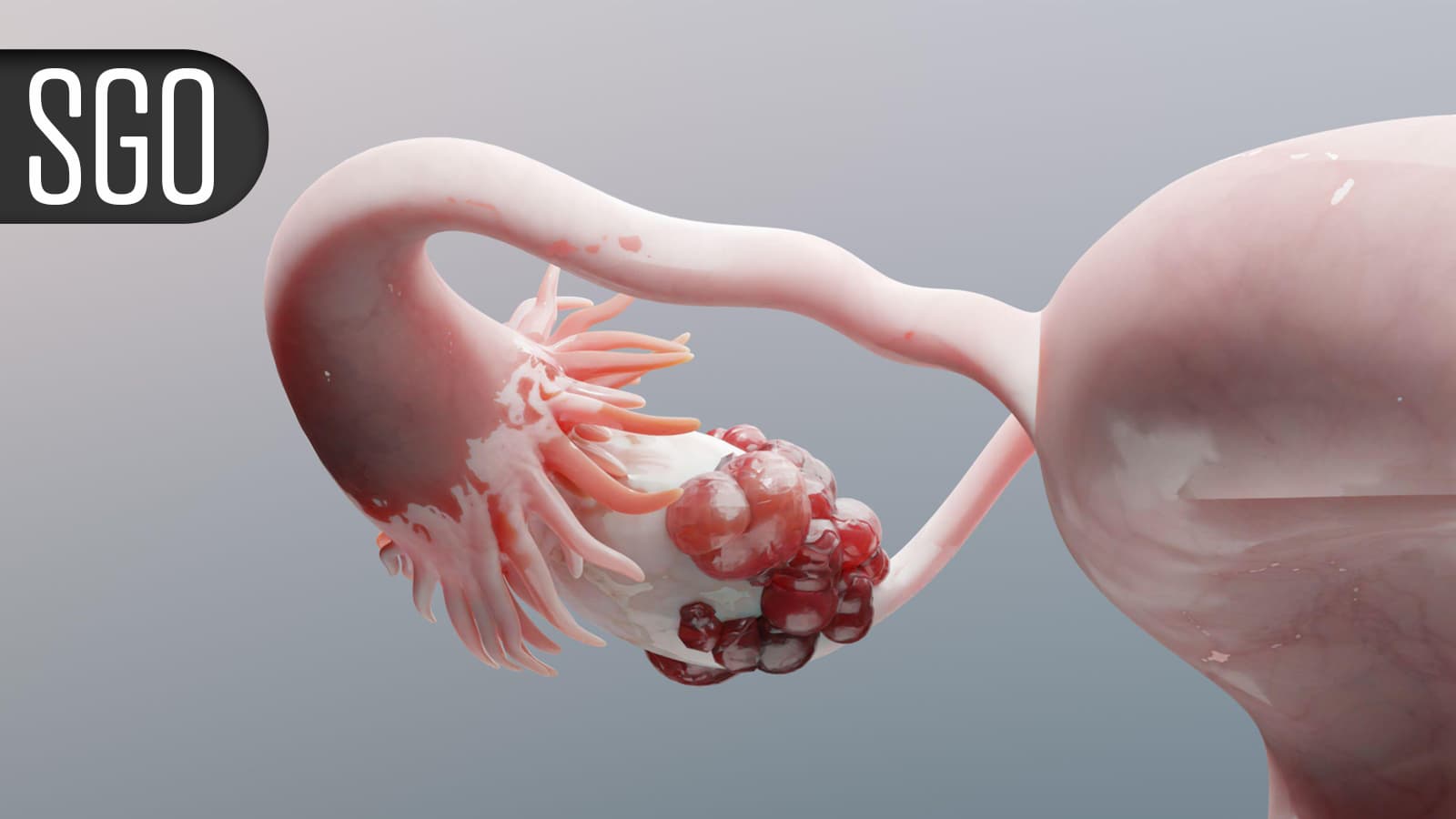 Chemo-Free Regimen for Endometrial Cancer Produces Durable Responses, Favorable PFS