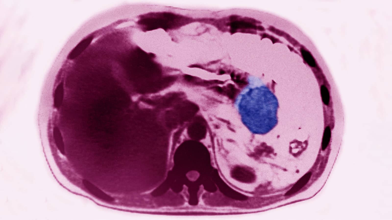 Pancreatic Cancer Risk Much Higher for Certain Group, Study Suggests