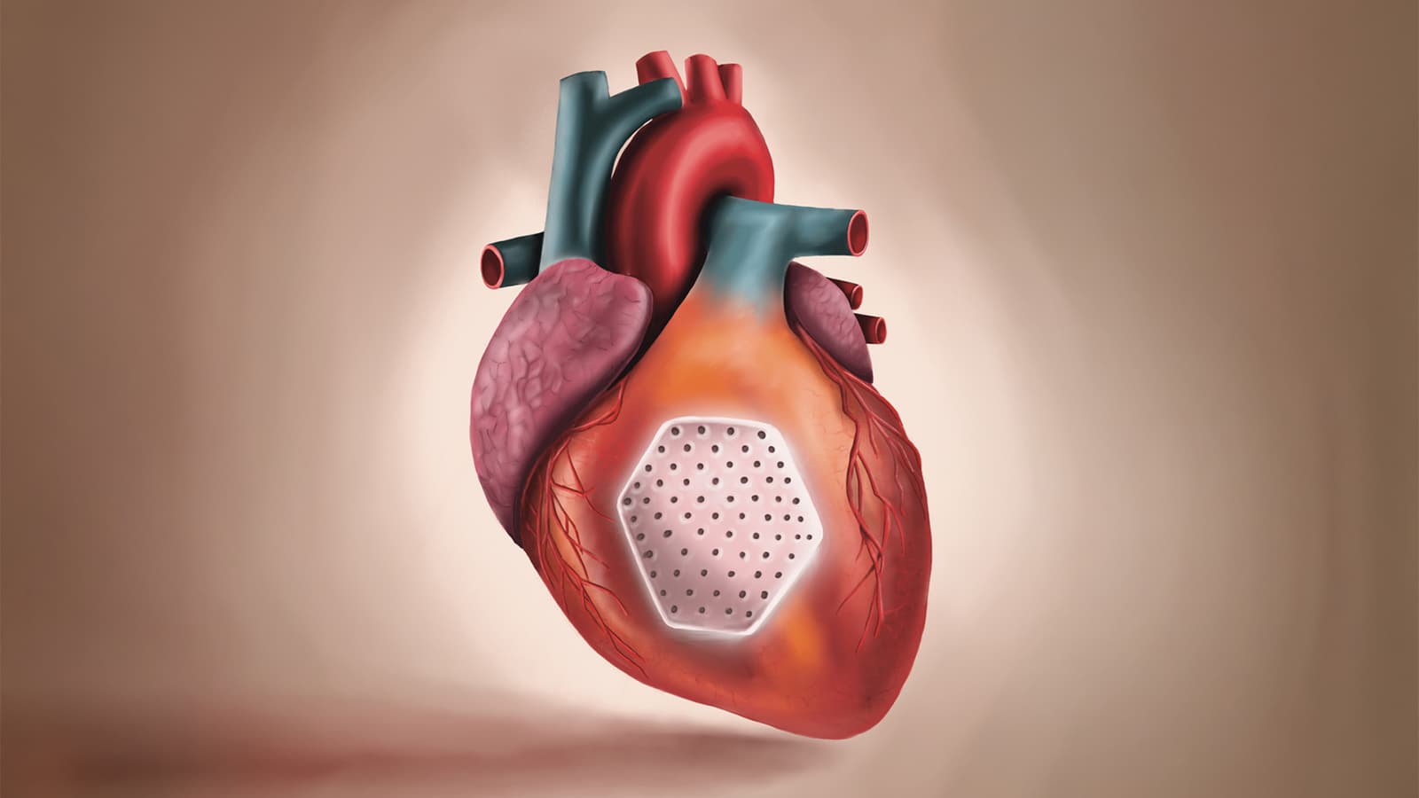 Dawn of Heart Muscle Patches to Address Lost Myocardium in Heart Failure