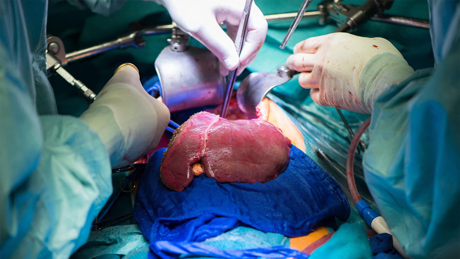 Perfusion Preservation Strategy Boosts Liver Transplant Outcomes