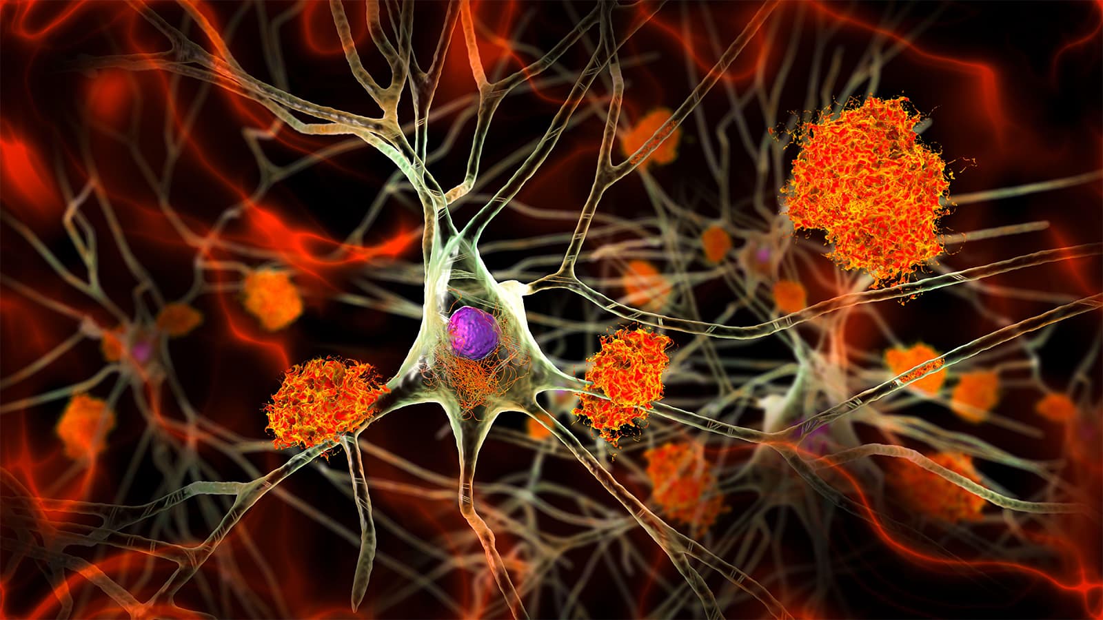 Alzheimer's Signs Hidden in Midlife Brains, Study Shows