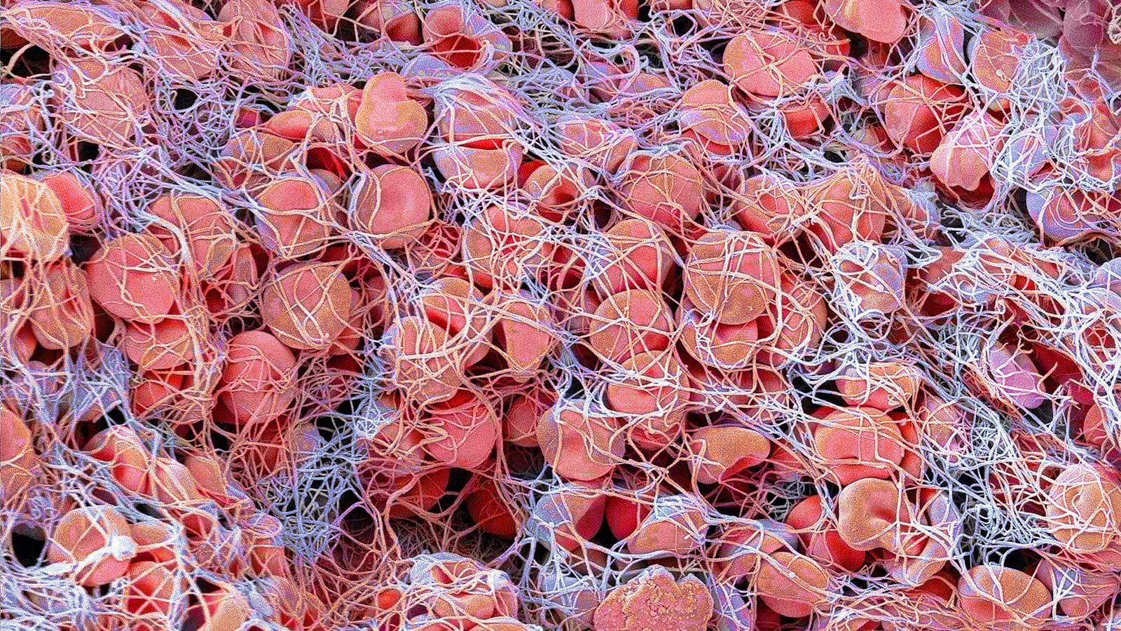 Tenecteplase Unseats Low-Dose Alteplase Favored for Asian Patients