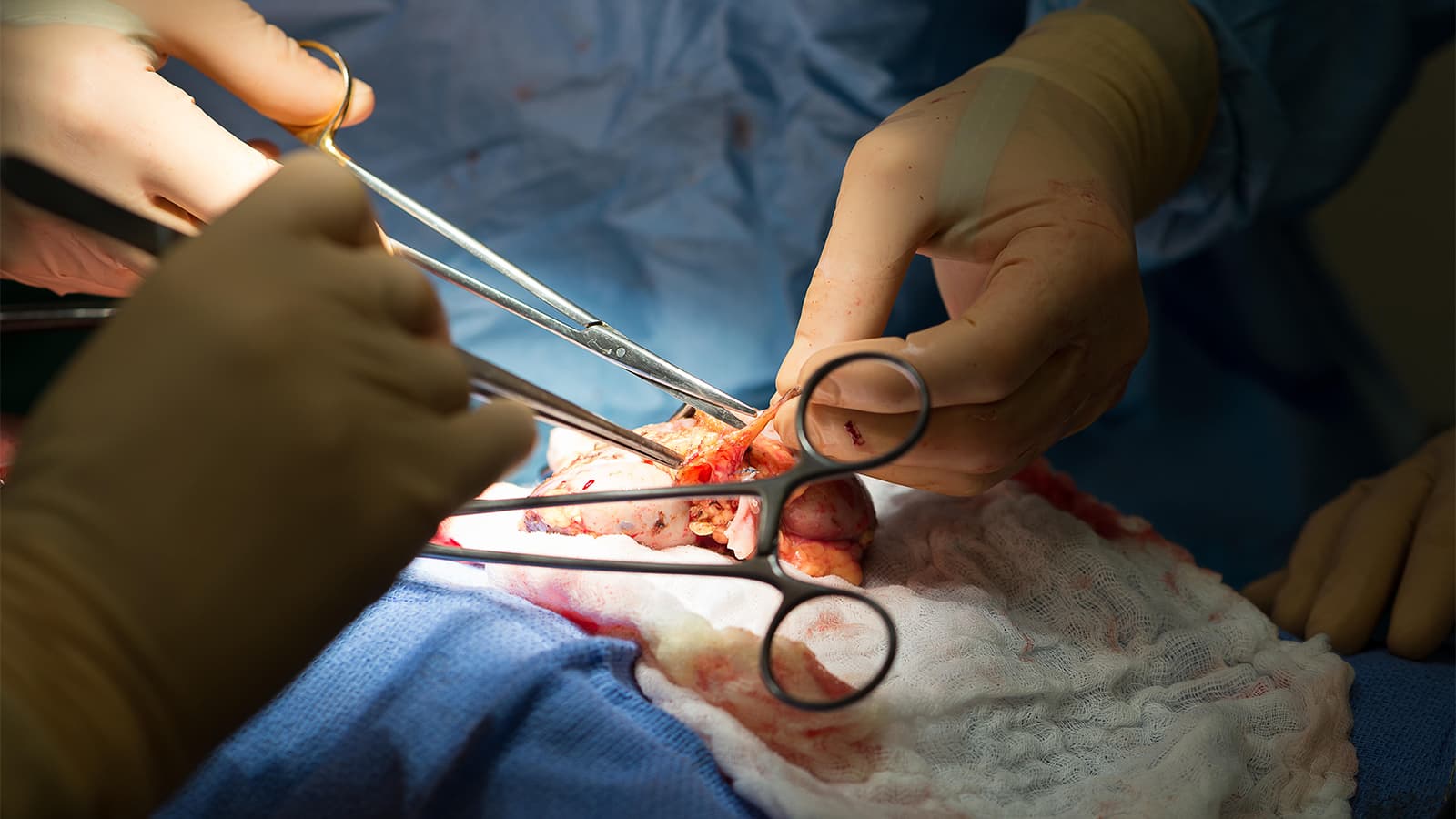 CAR T-Cell Therapy Enabled Kidney Transplant in Highly Sensitized Patients