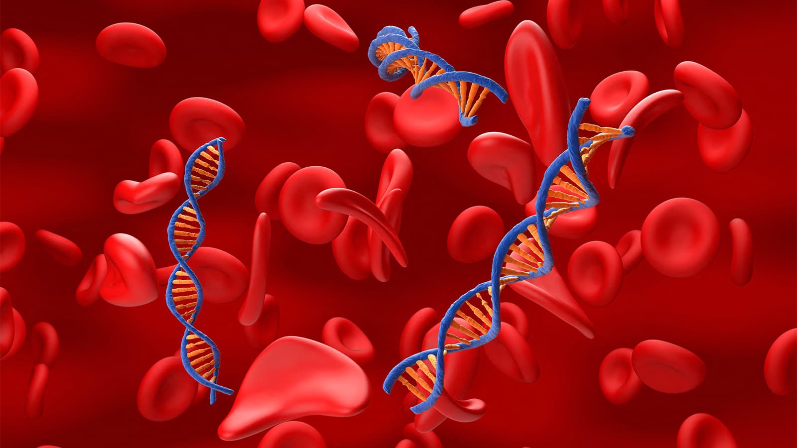 Stem Cell Transplant for Sickle Cell Disease More Cost-Effective Than Gene Therapy
