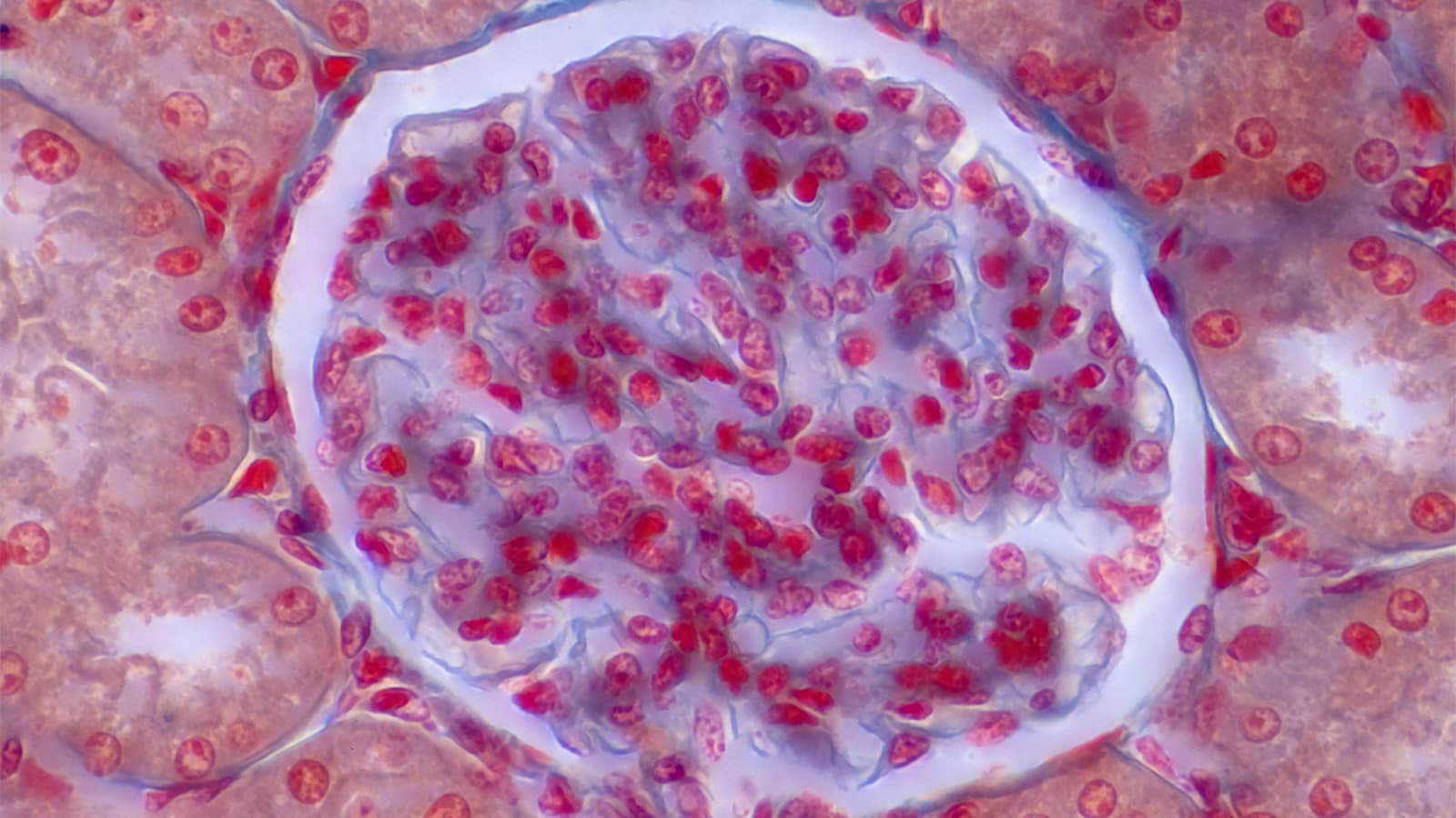 APOL1 Gene and Focal Segmental Glomerulosclerosis