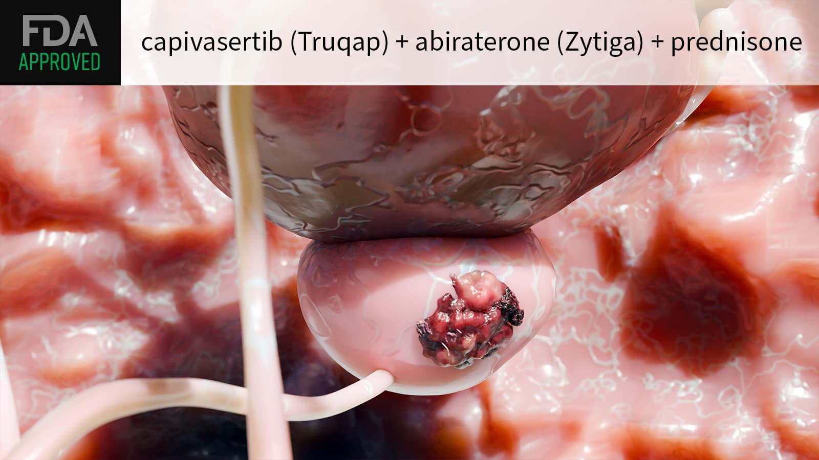 FDA Approves Prostate Cancer Combo That Warranted Advisory Meeting