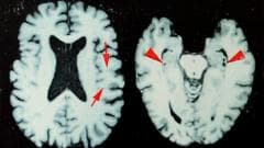 Brain disease in dead NFL players 'higher than previously shown'