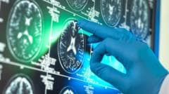 'Breakthrough' Alzheimer's drugs unlikely to benefit patients, report suggests