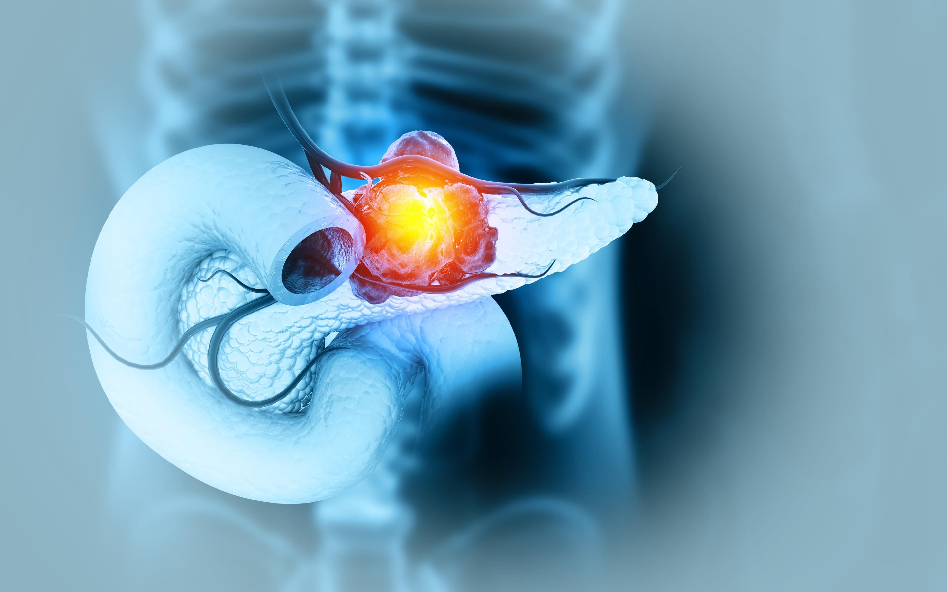 In Fight Against Pancreatic Cancer, Daraxonrasib Is Rare Sign Of Hope