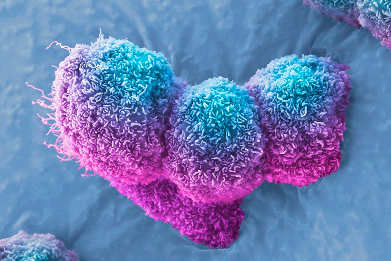 Pancreatic cancer halted by virus injection in three patients
