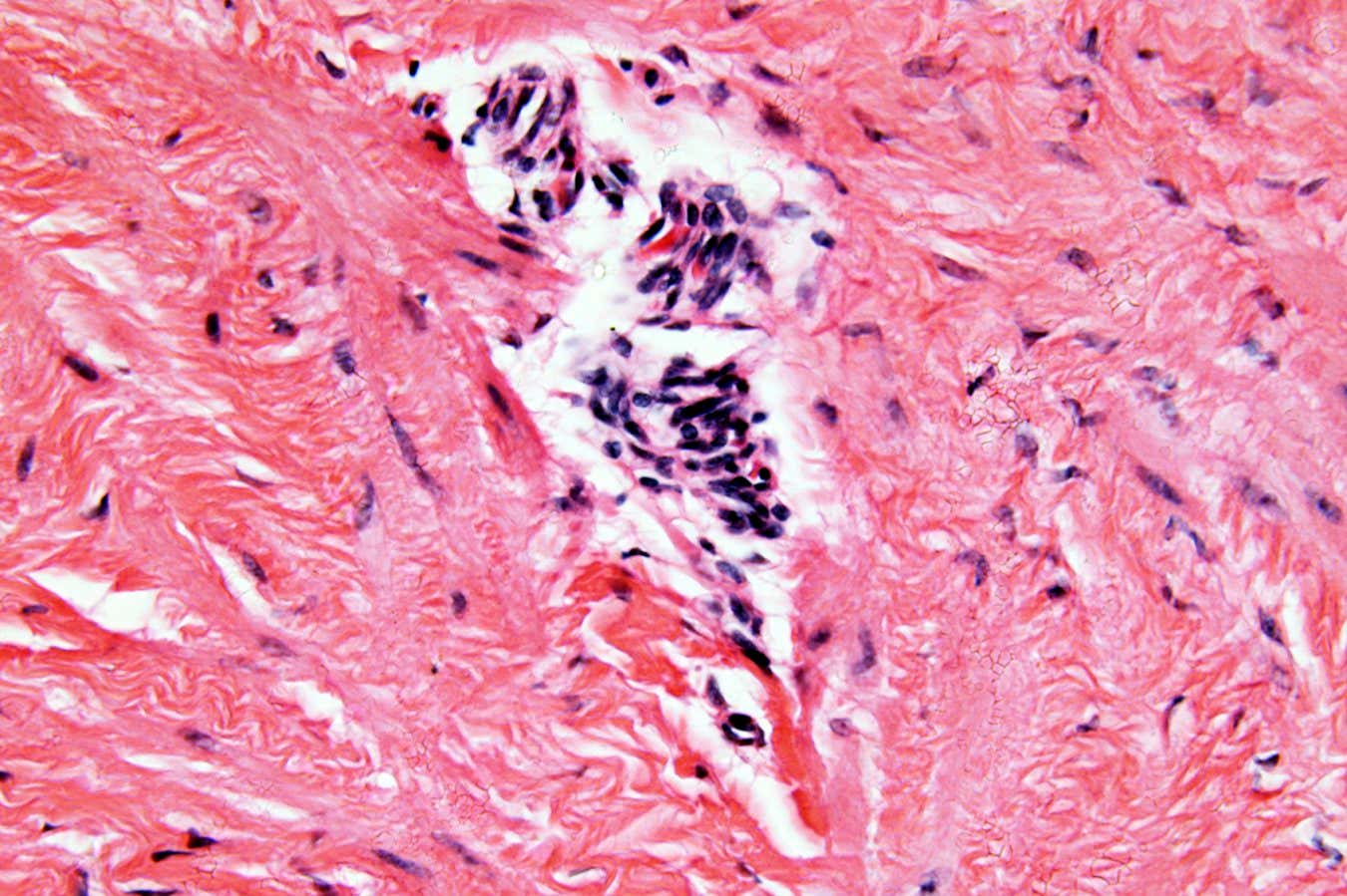 Unpicking endometriosis reveals how it affects more than the pelvis