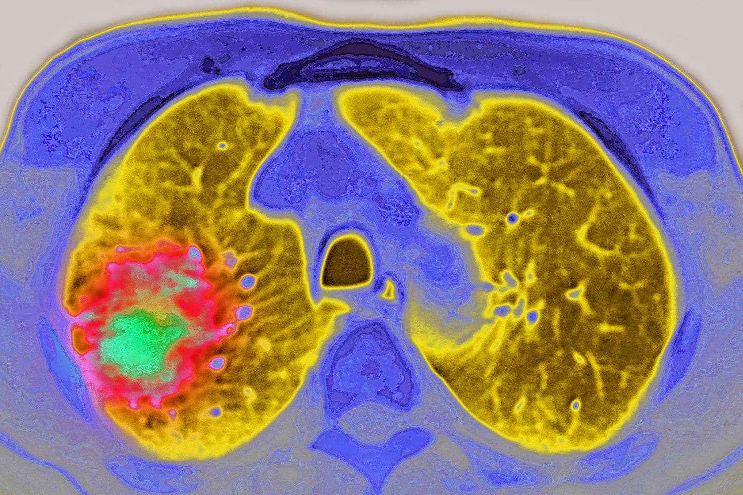 GLP-1 drugs may reduce the risk of cancer progressing, study suggests
