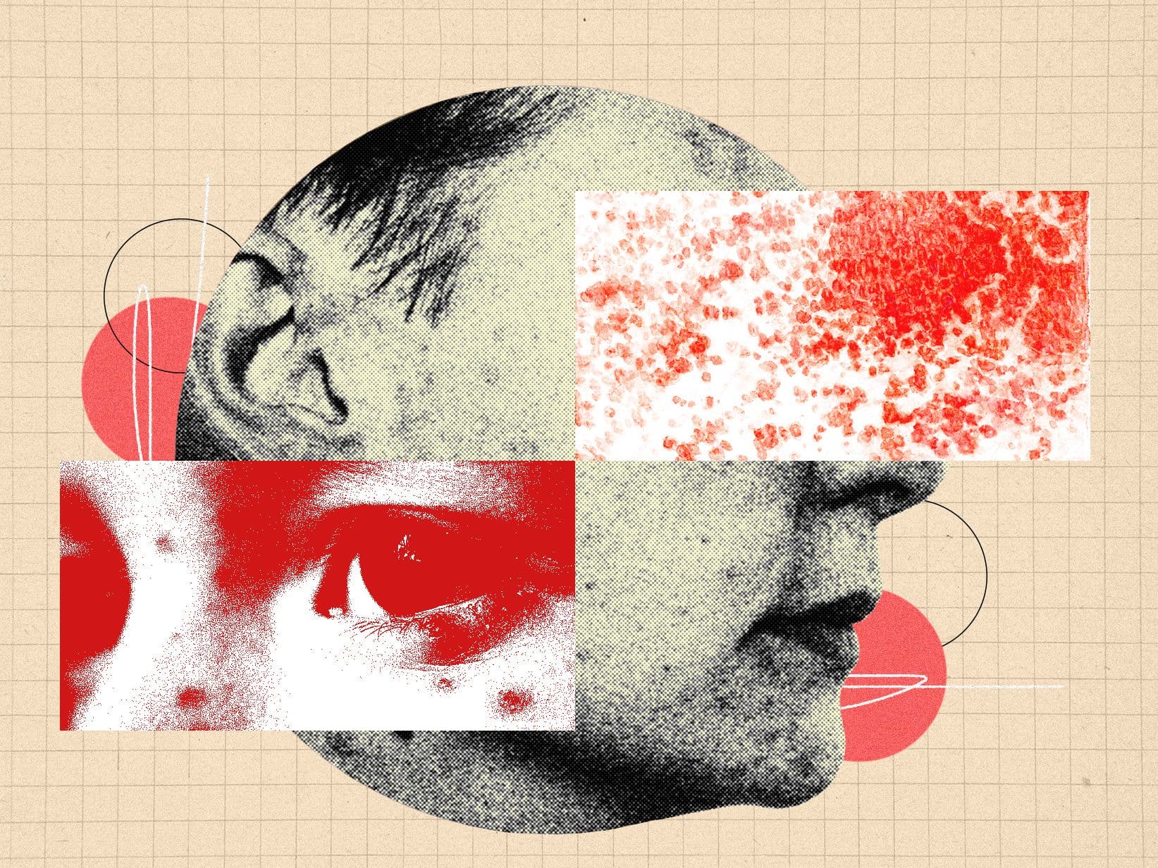 You Should Be More Freaked Out by Shingles