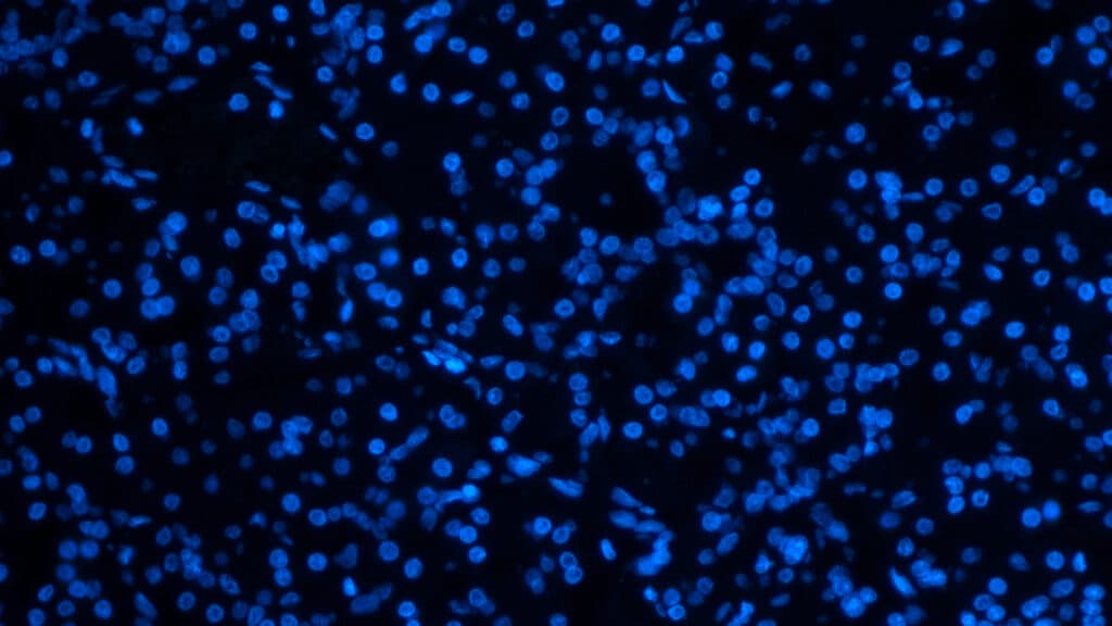 STAT+: Ahead of ASCO, all eyes on pancreatic cancer