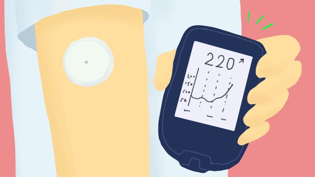Dexcom RCT suggests CGM benefits for broad diabetes population