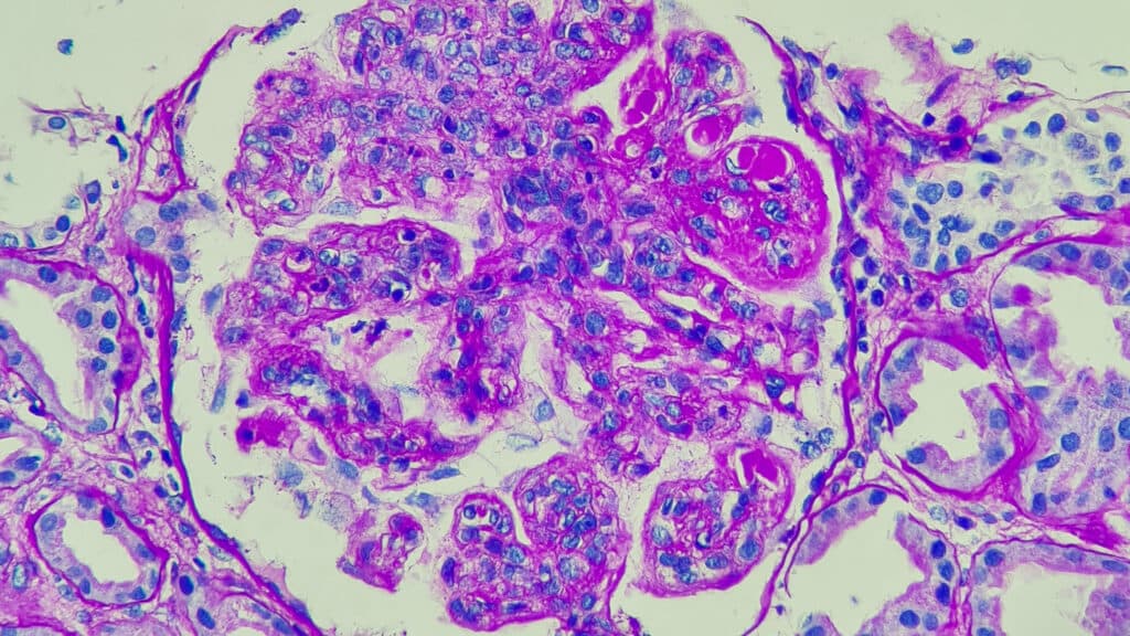 STAT+: 5 years after lupus breakthrough, CAR-T is still surprising autoimmunity researchers