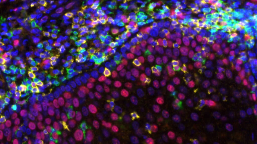 Ultra-low doses could bring costly cancer treatments to more patients in poorer countries
