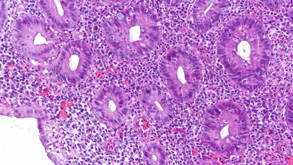 STAT+: Abivax ulcerative colitis drug shows strong efficacy, but cases of cancer raise concerns