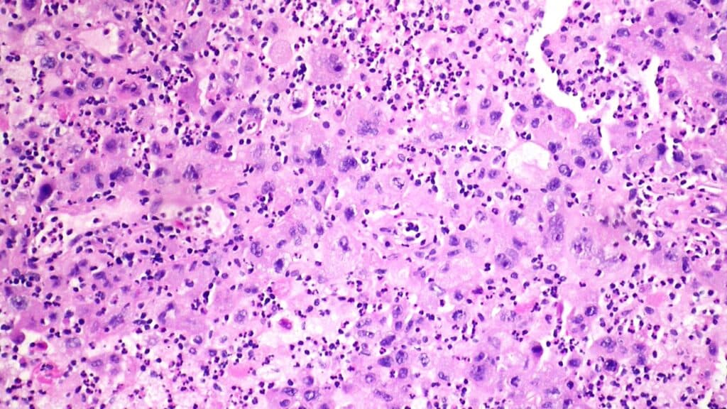 STAT+: Merck-Kelun lung cancer drug cut risk of tumor progression by 65%, ASCO abstract shows