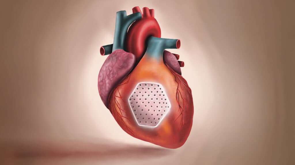 STAT+: Heart patch engineered from stem cells revved up weakened hearts