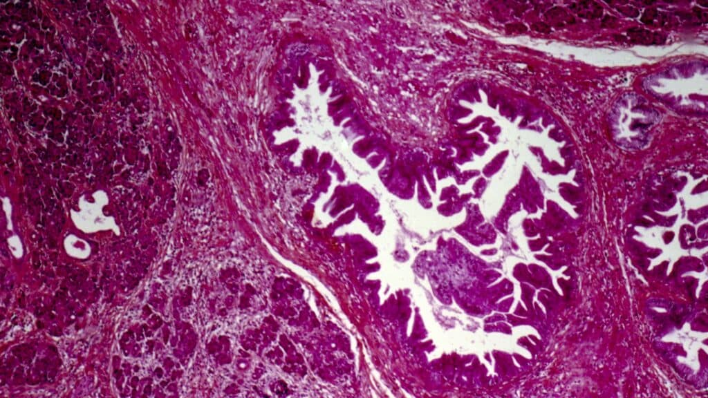 STAT+: A turning point for pancreatic cancer patients