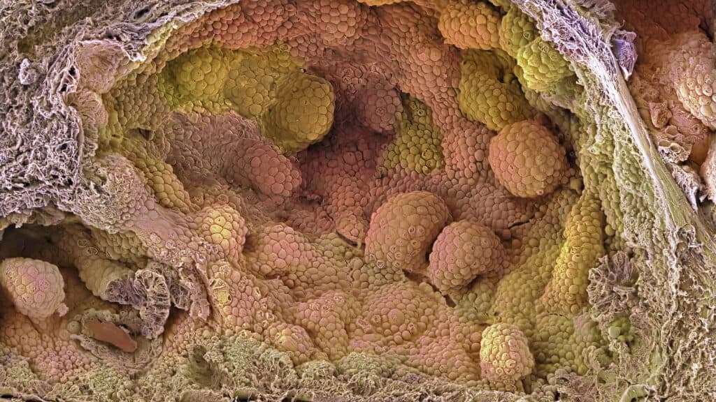 STAT+: For prostate cancer patients set on surgery, new hormone regimen may improve outcomes, study finds